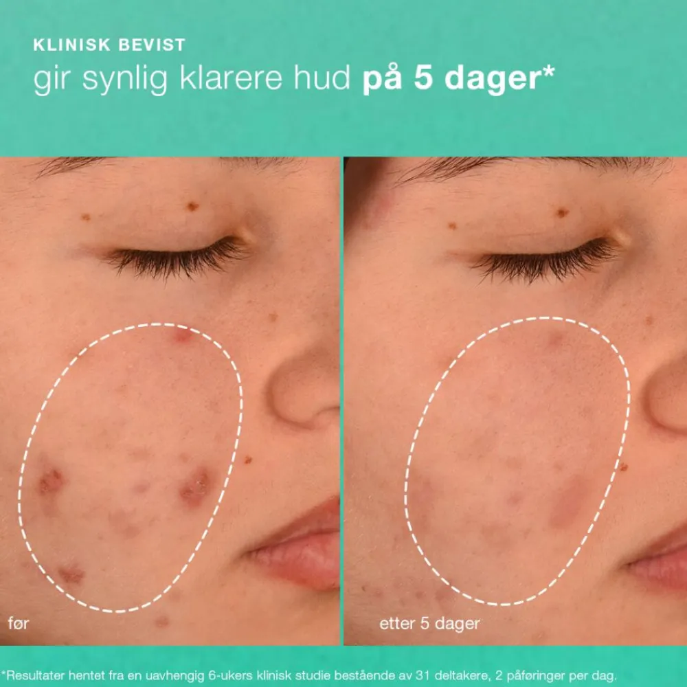 Dermalogica Ansiktskrem|Breakout Biotic Moisturizer