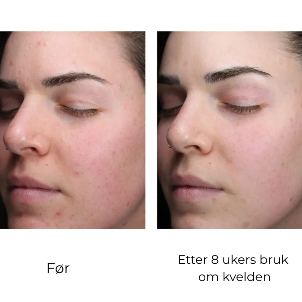 Skinbetter-Science Serum Og Ampuller|Skinbetter AlphaRet Clearing Serum