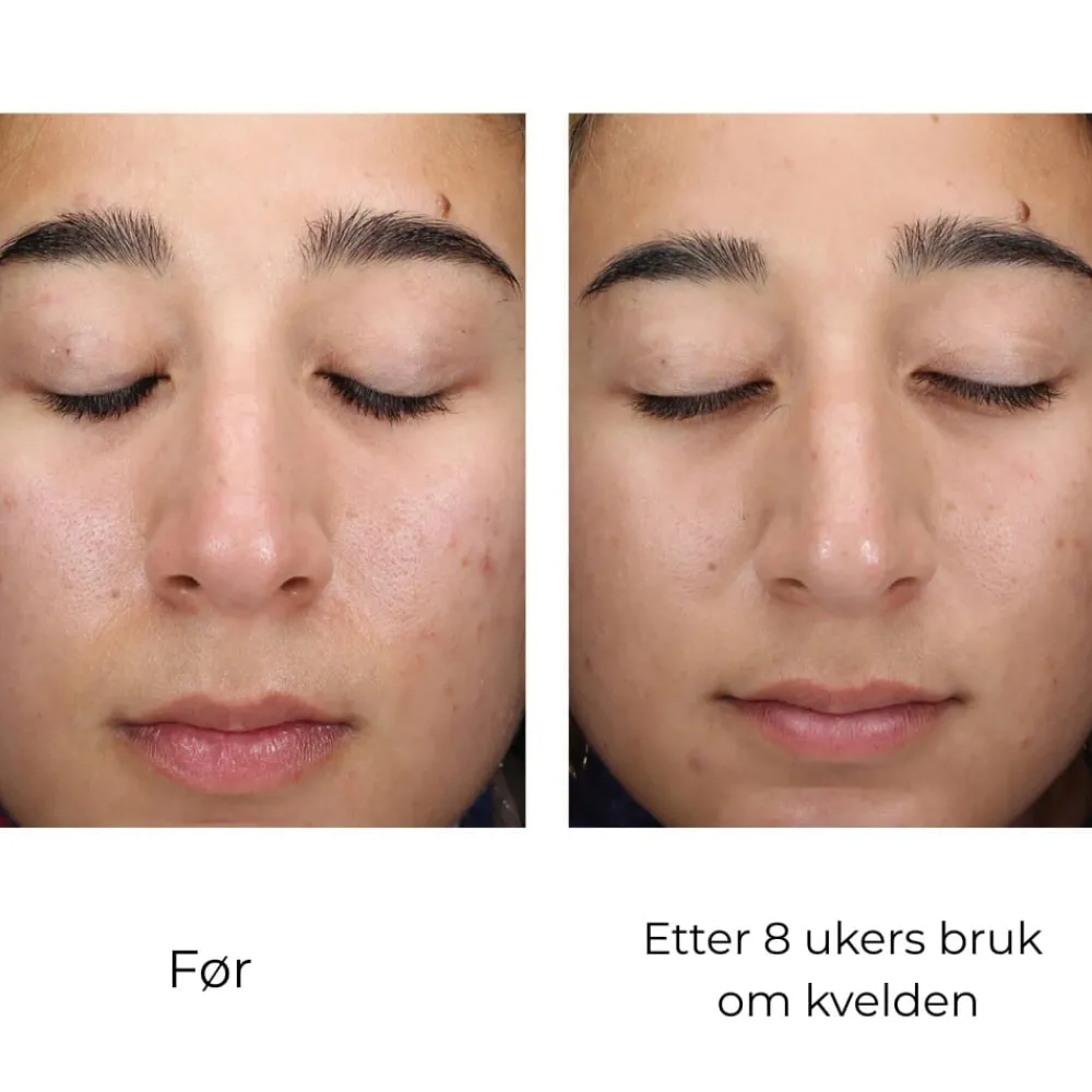 Skinbetter-Science Serum Og Ampuller|Skinbetter AlphaRet Clearing Serum