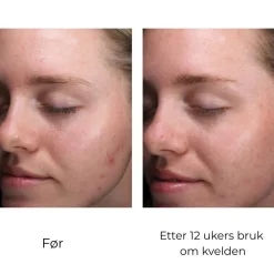 Skinbetter-Science Serum Og Ampuller|Skinbetter AlphaRet Clearing Serum