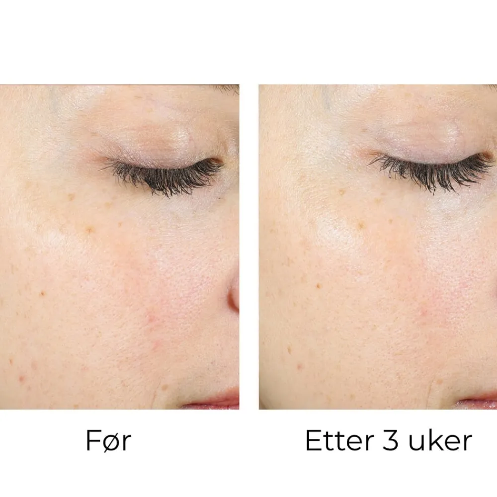 Skinbetter-Science Peeling Og Pads|Skinbetter AlphaRet Exfoliating Peel Pads (30stk)