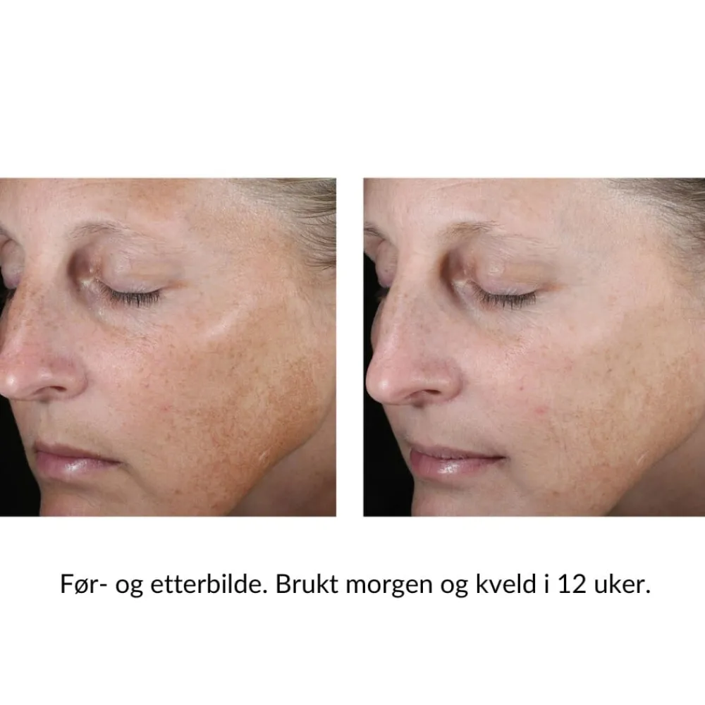 Skinbetter-Science Gravid Og Ammende|Serum Og Ampuller|Skinbetter Even Tone Correcting Serum