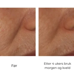 Skinbetter-Science Serum Og Ampuller|Skinbetter InterFuse Intensive Treatment Lines