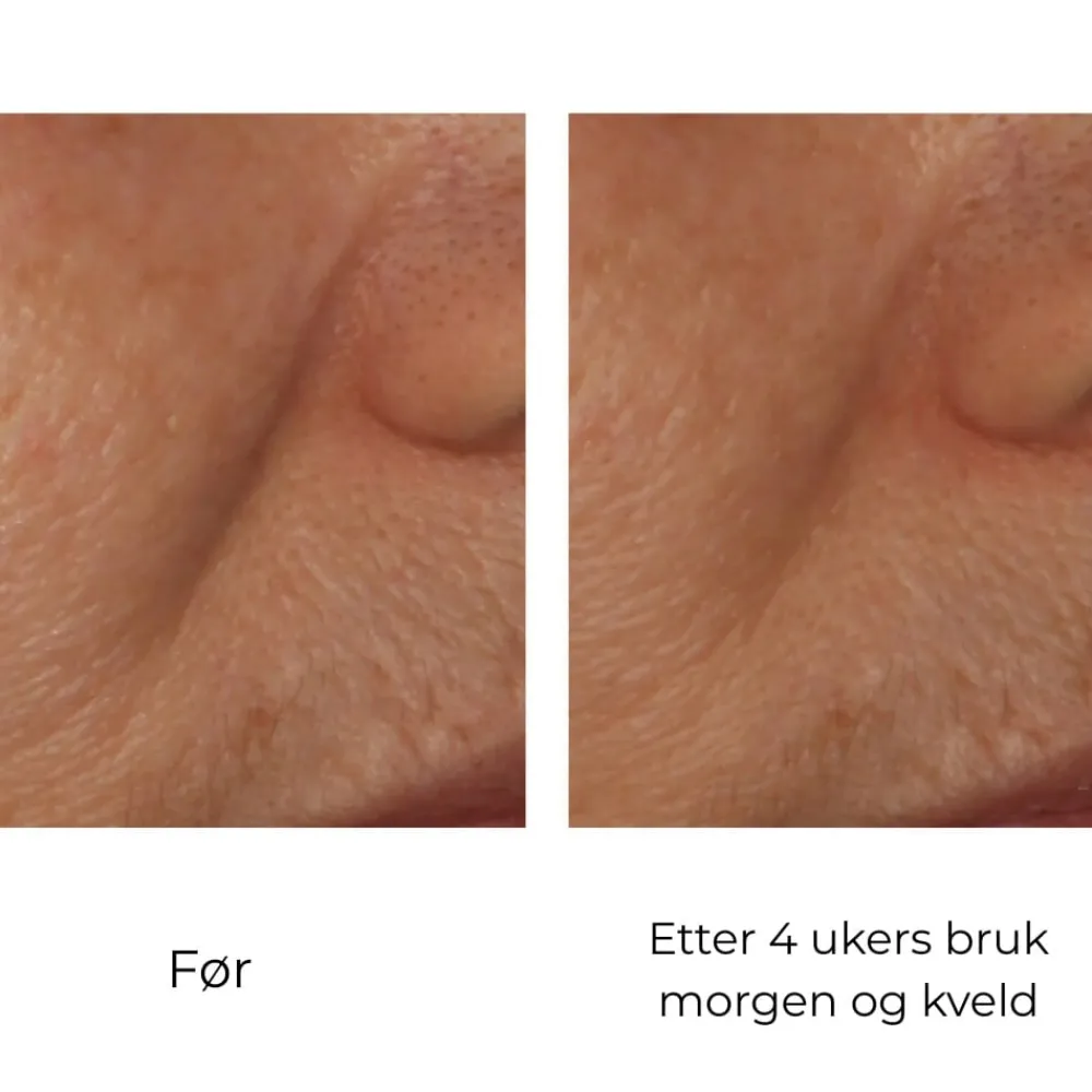 Skinbetter-Science Serum Og Ampuller|Skinbetter InterFuse Intensive Treatment Lines