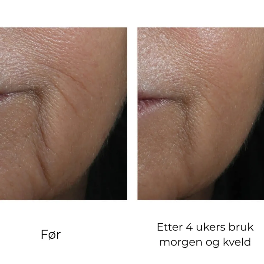 Skinbetter-Science Serum Og Ampuller|Skinbetter InterFuse Intensive Treatment Lines