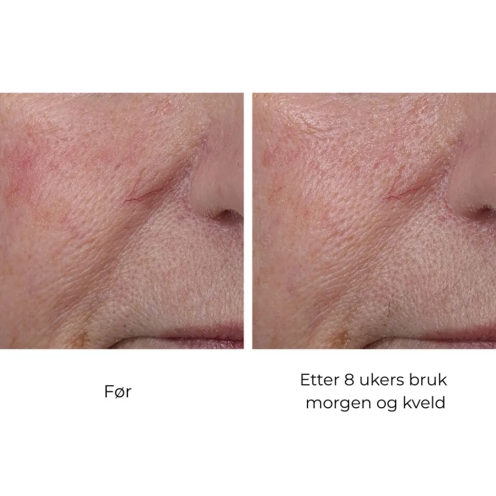 Skinbetter-Science Ansiktskrem|Skinbetter InterFuse Treatment Cream Face & Neck