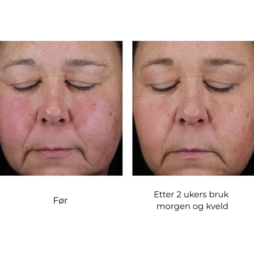 Skinbetter-Science Serum Og Ampuller|Skinbetter Mystro Active Balance Serum