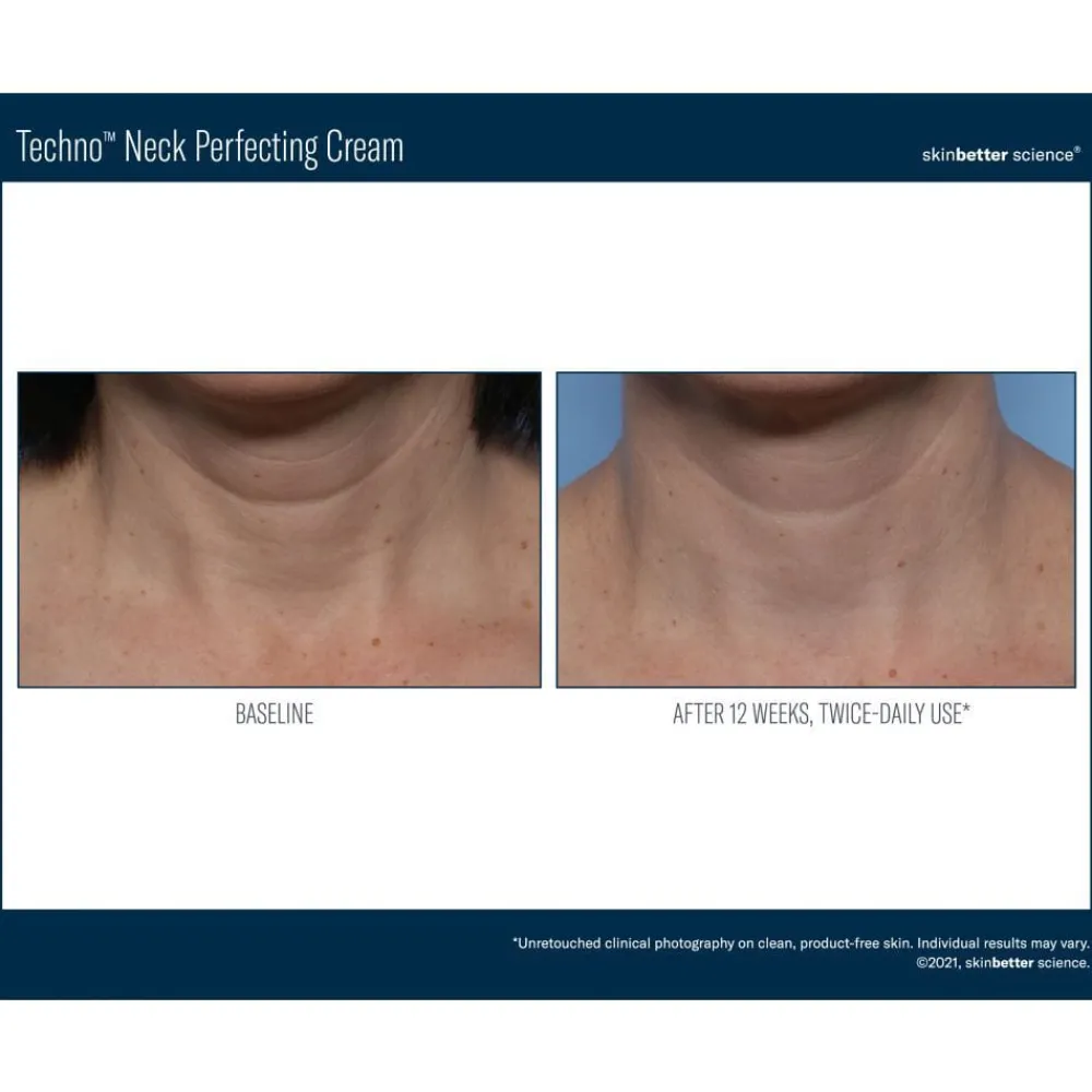 Skinbetter-Science Ansiktskrem|Hals Og Décolleté|Skinbetter Techno Neck Perfecting Cream
